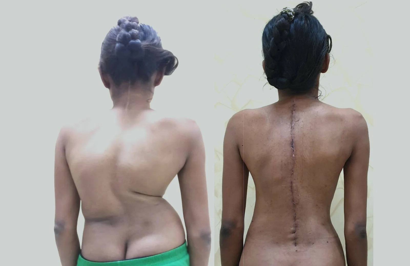 Side-by-side back views showing a person's spine: left with uneven back, right with a long vertical surgical scar after spinal surgery.